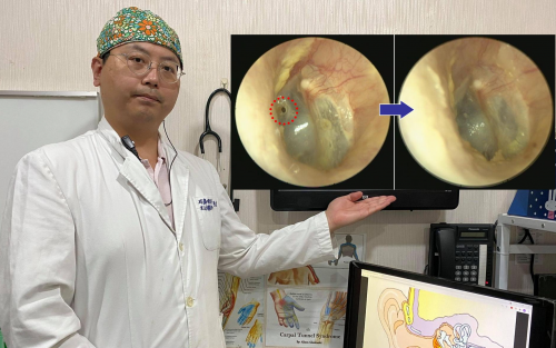 耳鸣？可能是罹患慢性中耳炎造成耳膜穿孔